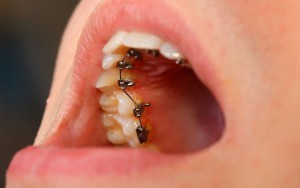 Close up of a lingual braces at a dental clinic